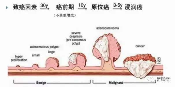 體檢查出腸息肉一定要切除！ 95%腸癌由它演變而來