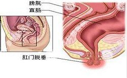 南寧治療脫肛哪家醫(yī)院好？南寧脫肛治療多少錢？